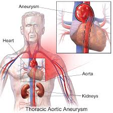 Thoracic Aortic Aneurysm Wikipedia