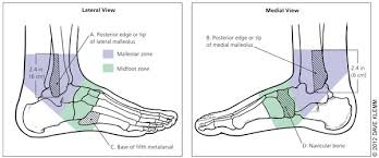 Ankle Injuries  Pain  Causes  Treatment and How to Return to       