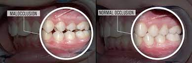 occlusion behind your bite a