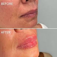 lip filler swelling ses a week by