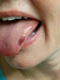 Bacteria builds up in your mouth soon after. Nocturnal Epileptic Seizures And Their Oral Complications Dentistryiq