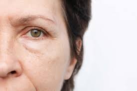 puffy eyes causes and remes