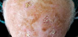 actinic keratosis dermatology and