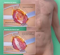 incisional hernia repair by dr david w