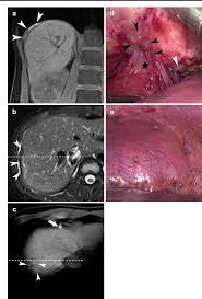 Ct scans may show certain. Figure 3 From Mr Diagnosis Of Diaphragmatic Endometriosis Semantic Scholar