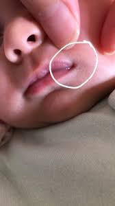 what s this in corner of baby s mouth