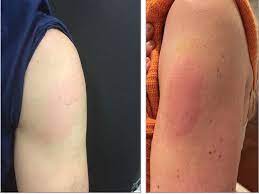 The side effect, dubbed covid arm has occurred in a small number of patients in the us. Moderna Vaccine Can Trigger Red Itchy Covid Arm But It S Temporary