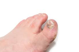 fungal nails in fort worth arlington