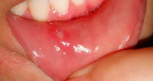 aphtous ulcer and herpes mouth wounds