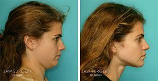 There are three primary methods of correcting an overbite: Before After Photos Los Angeles Ca Jaw Surgery La