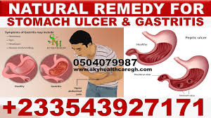 natural cation for stomach ulcer in