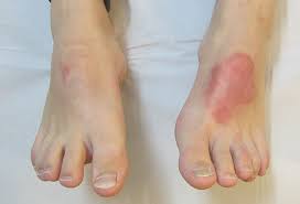 foot eczema due to octylisothiazolinone