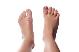 eczema on children s feet surprise