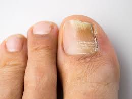 fungal infections fitzroy foot and