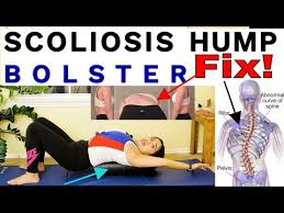 scoliosis curvature rib hump pilates