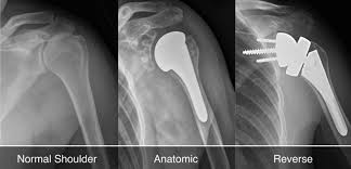 shoulder replacement laud clinic