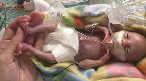 Born Before 22 Weeks Most Premature Baby Is Now Thriving