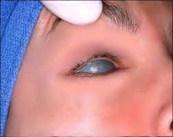 ipl therapy crystal vision optometry