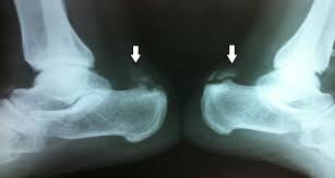 Insertional achilles tendinopathy retrocalcaneal bursitis haglund deformity (i.e. Https Www Ijoro Org Index Php Ijoro Article Download 766 441