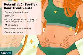 how do i take care of a c section scar