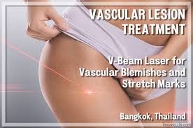vascular lesion treatment v beam laser