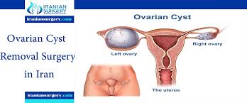 ovarian cyst surgery cost iin iran