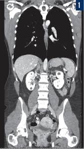 Some people refer to a ct scan as a cat scan, which stands for computerized axial tomography. A Woman With Abdominal Pain Is Found To Have Renal Cysts What S The Cause Nephrology