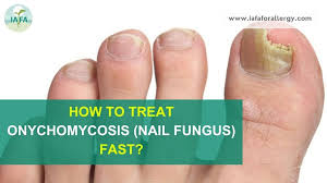 treat onychomycosis nail fungus fast