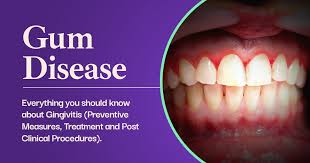 gum disease everything you should