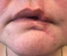 lip scar correction best wound practice