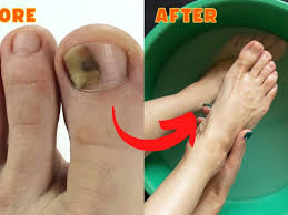 natural cure for toenail fungus