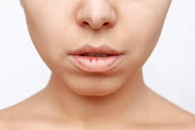 dry mouth xerostomia causes symptoms