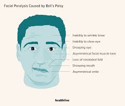 bell s palsy causes symptoms