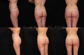 Brazilian Butt Lift | L. SCOTT ENNIS MD, FACS Plastic Surgeon