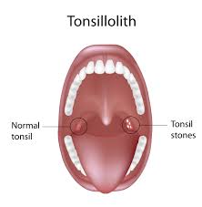Should You Be Worried About Tonsil Stones Warped Speed