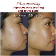 active acne with microneedling skinpen