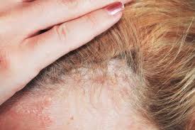 psoriasis hair loss what stimulates