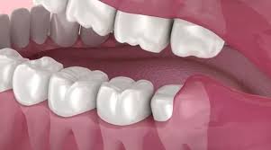 Your dentist may remove your wisdom teeth, or they may refer you to a specialist surgeon for hospital treatment. Wisdom Teeth Removal Santa Fe Nm Taos Nm Los Alamos Nm Espanola Nm Las Vegas Nm Oral Surgery And Dental Implant Center Of Santa Fe