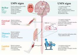 diagnosis of amyotrophic lateral sclerosis