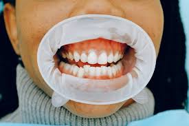 wisdom teeth out help with gum disease