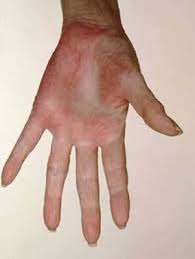 A number of medical conditions can cause this clinical sign, and some people also experience such reddening when they are in normal health. Palmar Erythema Treatment Orthopedics Preparation