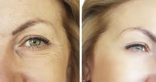 types of cosmetic eyelid surgery