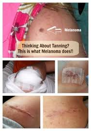 Melanoma is one of the most serious forms of cancer, and because its appearance can closely mimic natural moles, freckles, and age spots, it can be easy to overlook. Pin On Melanoma Awareness