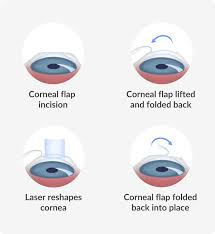 lasik eye surgery optical centre