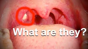 nasty white chunks in your throat