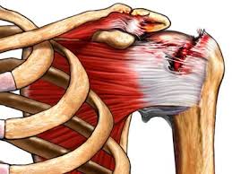csípő fájdalom a csípő területén térdízület kezelése szokásos diszlokáció