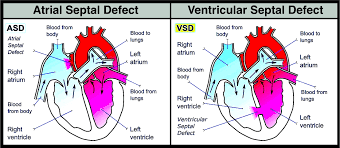 Atrial Septal Defect Vs Ventricular Septal Defect Both