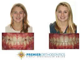 The reason is you can move teeth to a certain limit. Can Invisalign Fix Overbites And Other Bite Problems Premier Orthodontics