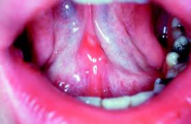 hiv and other viruses in the mouth