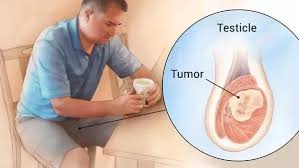 The first step in diagnosing testicular cancer. What Are The Symptoms Of Testicular Cancer Quora